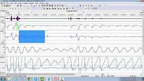 23. RemLogic Manual Scoring for the Respiratory Events