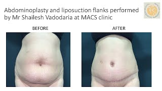 Abdominoplasty