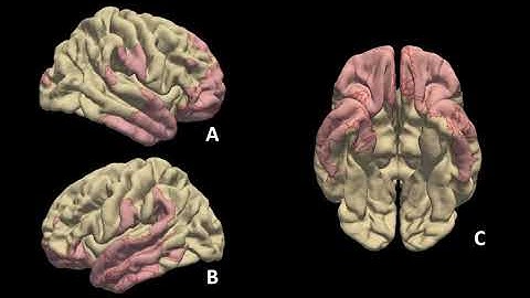 Video 3 - Visualization of Individual Lesion Topology on the Cortical Surface