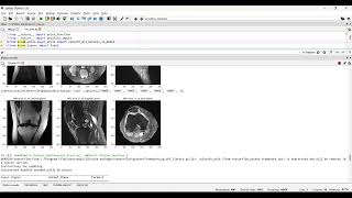 Knee Segmentation MRI Train CNN in Python Projects