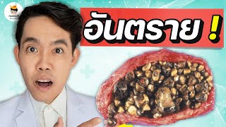 10 ความเสี่ยง กระตุ้น นิ่วในถุงน้ำดี อันตราย (จบในคลิป) | หมอแบงค์ food doctor