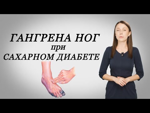 Гангрена ног при сахарном диабете.