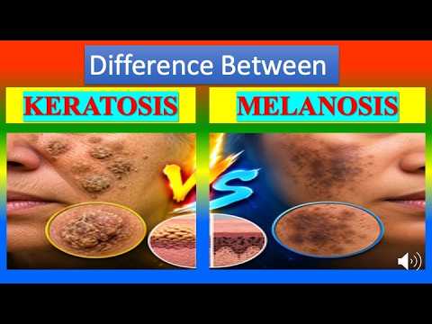 Differences between Keratosis and  Melanosis