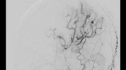 STA-MCA bypass supplying MCA territory after bypass surgery