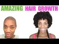 I Naturally Cured My Alopecia - 2 Years Alopecia Free - No Bald Spots