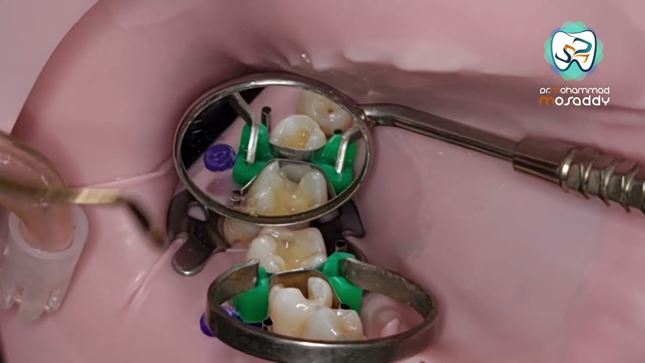 بناء نقطة التماس بين الأسنان contact point مع ملاحظات بالكومبوزيت