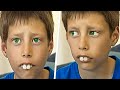 School Kids Laughed At His Rabbit Teeth. But a Few Years Later He Surprised Everyone!