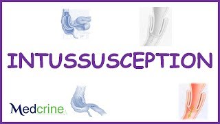 Intussusception : causes, types , pathophysiology,features,dx and treatment