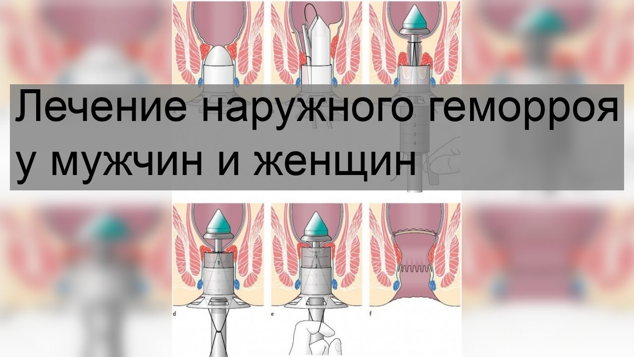Лечение наружного геморроя у мужчин и женщин - YouTube