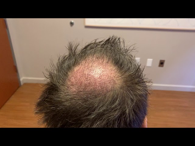 Dallas Male Hair Transplant Testimonial One Day Out