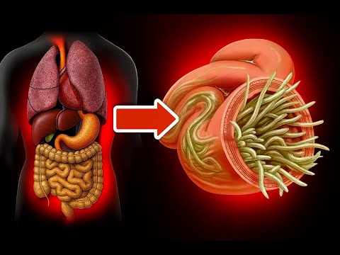 ИЗБАВЬТЕСЬ ОТ ПАРАЗИТОВ В КИШЕЧНИКЕ 💥 ВСЕГО ЗА НЕСКОЛЬКО МИНУТ С ПОМОЩЬЮ ПРОСТЫХ ПРОДУКТОВ 🤯