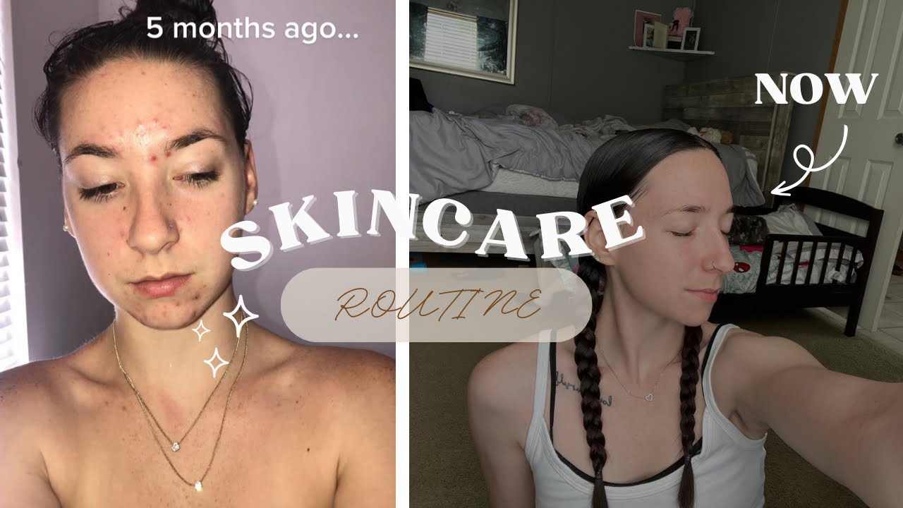 SKIN CARE ROUTINE! acne prone skin, tips, skincare, self love. - YouTube
