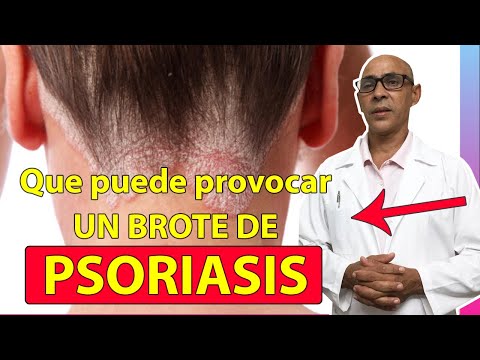 Vídeo: Psoriasis En Niños: Síntomas, Tratamientos Y Más