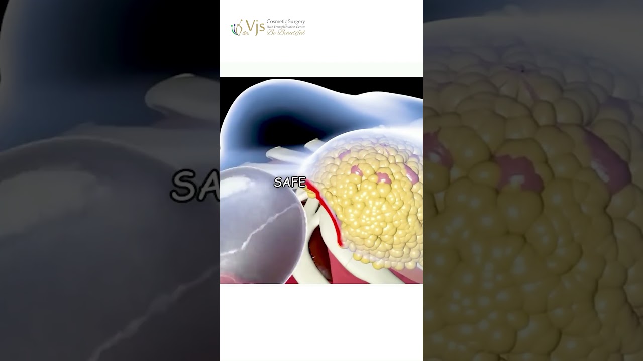 Breast Augmentation for Natural Results in Vizag | VJ’s Clinics