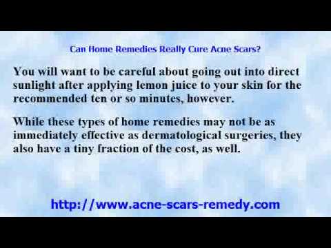 Removing Acne Scar Q&A: Can Home Remedies Really Cure Acne Scars?