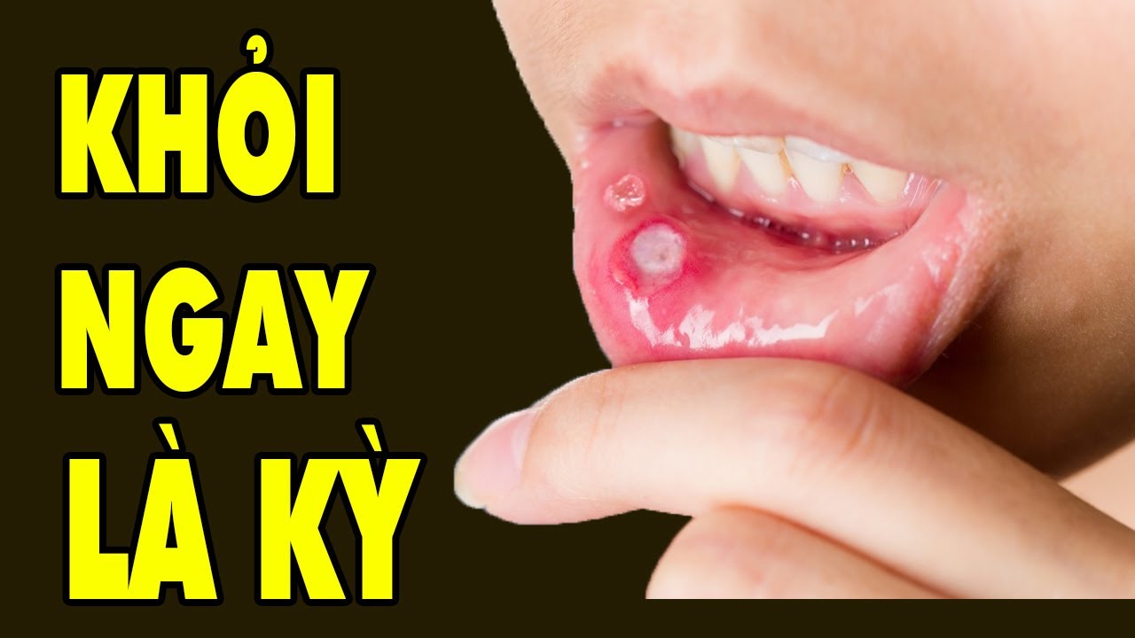 Mách Nhỏ Cách Chữa Nhiệt Miệng Đơn Giản Khỏi Ngay Tại Nhà 100% | HYT3