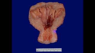 Pathology - dr. Nafea'a -- Neoplasia كل ما تريد عن الأورام