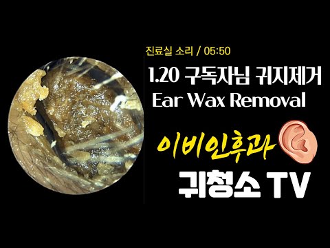 1.20 구독자님 귀지제거