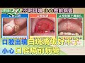 口腔出現白斑 嘴破好不了 小心口腔癌前病變 健康2 0 口腔出現白斑 嘴破好不了 小心口腔癌前病變 健康2 0
