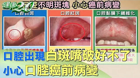 口腔出现白斑、嘴破好不了 小心口腔癌前病变 健康2.0 - 天天要闻