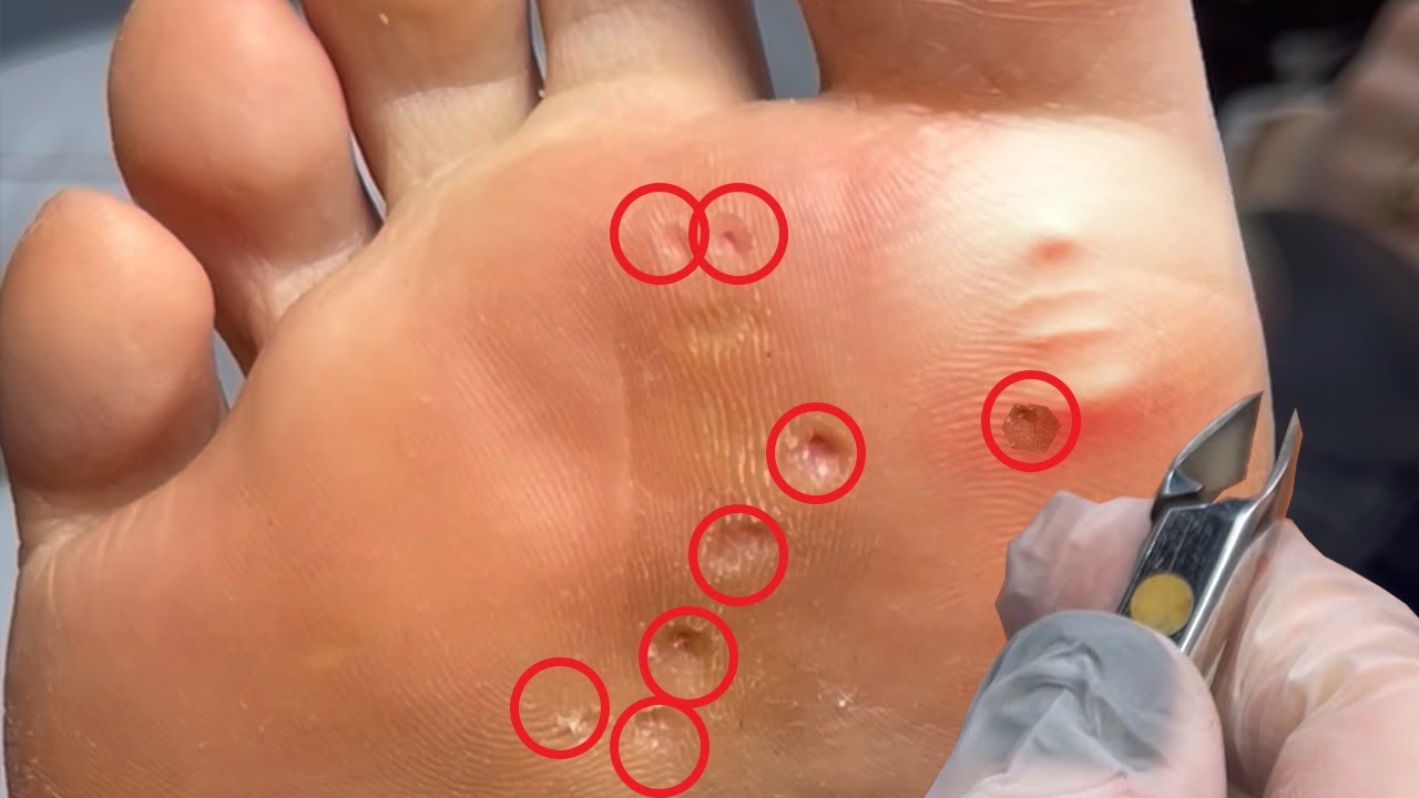 8 CALLUSES removal in 2 minutes YouTube