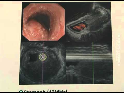 Video: Endoskopska Metoda Radialnega Razreza Za Dve Strukturi Požiralnika Po Endoskopski Submukozni Disekciji: Poročilo Primera