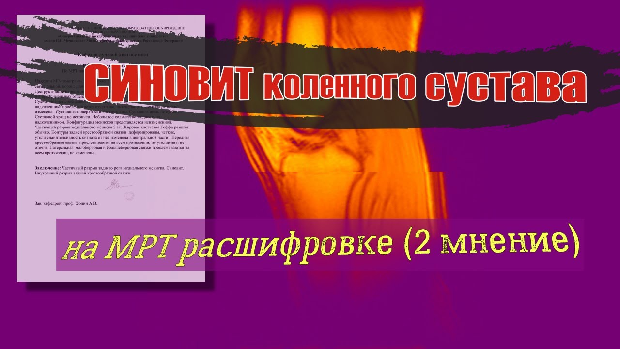 СИНОВИТ КОЛЕНА и РАЗРЫВ МЕДИАЛЬНОГО МЕНИСКА заднего рога на расшифровке ...