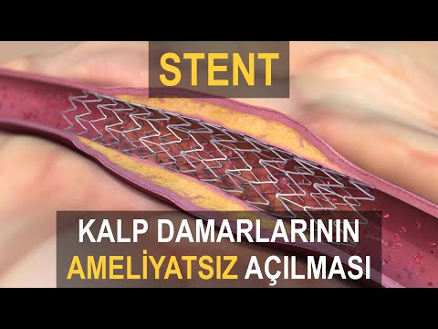 Stent: Temel Bilgiler