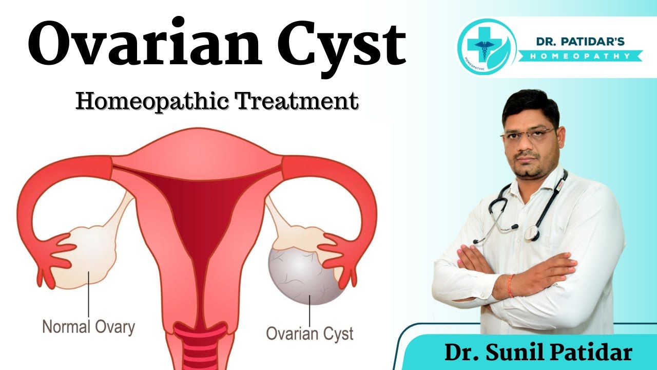 Ovarian Cyst Homeopathic Treatment Symptoms, Causes, Prevention Dr. Sunil Patidar ovarian