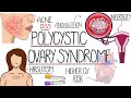 Polycystic Ovary Syndrome Made Easy (PCOS Explained)