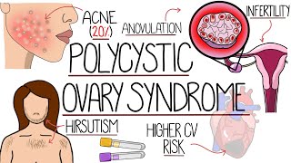 Polycystic Ovary Syndrome Made Easy (PCOS Explained) by Rhesus Medicine 46,906 views 6 months ago 8 minutes, 24 seconds