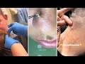 Best Satisfying Pimples Popping Cyst Removal Acne Blackheads Compilation Videos 23 Best Satisfying Pimples Popping Cyst Removal Acne Blackheads Compilation Videos 23