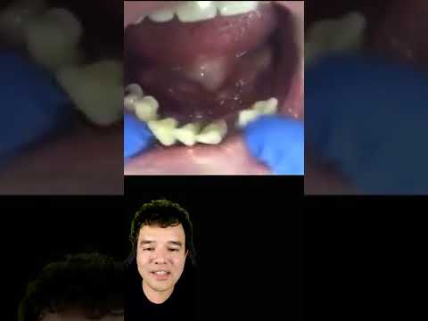Vídeo: Você deve forçar um dente solto?