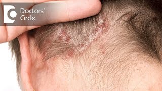 What is the management of Scalp Psoriasis?  - Dr. Rashmi Ravindra