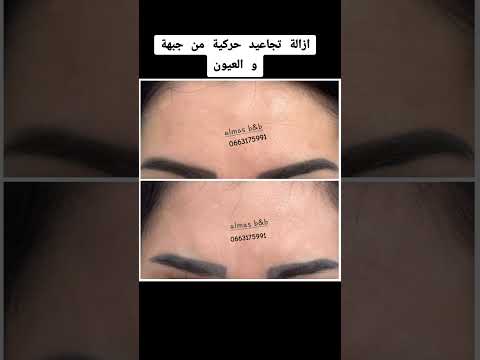 ازالة تجاعيد حركية من العيون 0663175991   مايكاب مكناس اكسبلور
