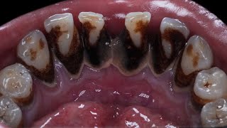 It’s very difficult to clean black stains that stick to teeth.