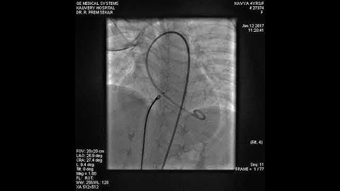 Device closure of perimembranous VSD without AV loop formation