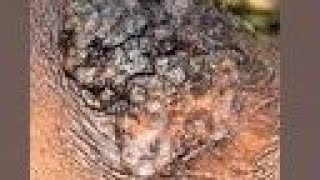 Satisfying videos, jiggers removal and cleaning, jiggers digging