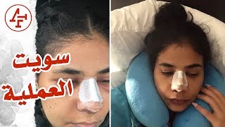 شوفو الصور، التكلفة، والتجربة بالكامل لعملية تجميل الأنف - Nose Job Surgery