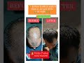 Hair regrowth treatment successful results ayurvedahairregrowthshortshairproblemshairhaircare