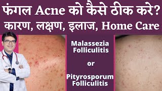 Fungal Acne Treatment In Hindi | फ़ंगल ऐक्नी का इलाज | Malassezia or Pityrosporum Folliculitis