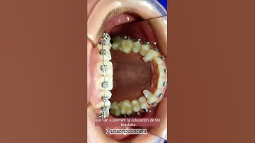 Corrección de mordida profunda. Topes o bite turbos. #short #ortodoncia