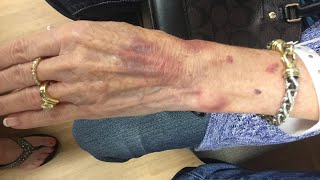 Family says Alzheimer's patient left in care of hospice worker was bruised