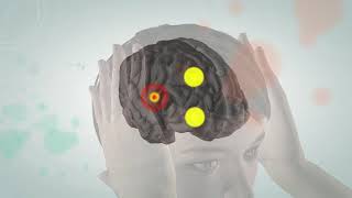 Animated video illustrating the pathophysiology of migraine