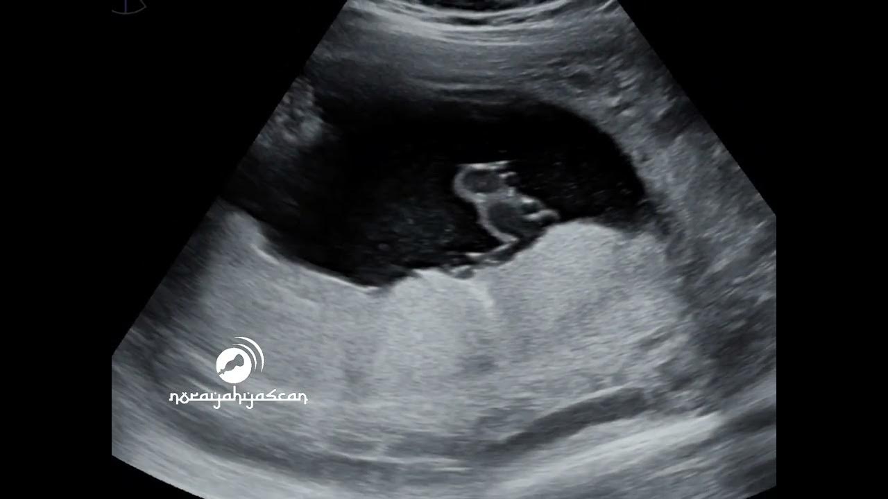 Cord Insertion And 3 Vessel Cord Using Color Doppler YouTube cord-insertion-and-3-vessel-cord-using-color-doppler-youtube