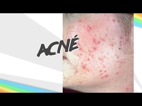 Acné - que es el acne y como funciona | video archivo de la Frikipedia