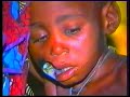 1994 - Noma, pathologie oubliée... Ouma, Ismael, Ramata, et les autres (Images pouvant heurter)