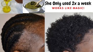 This Only 2 Ingredients Oil Thickens Hair Like Magic! Helps To Treat Bald Spots and  Hair Loss