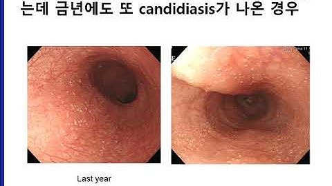 asymptomatic candidiasis 무증상 칸디다증