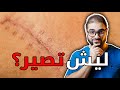7 الأخطاء الشائعة بخياطة الجروح خياطة الجروح بالطريقة الصحيحة 5 5 سلسلة خياطة الجروح